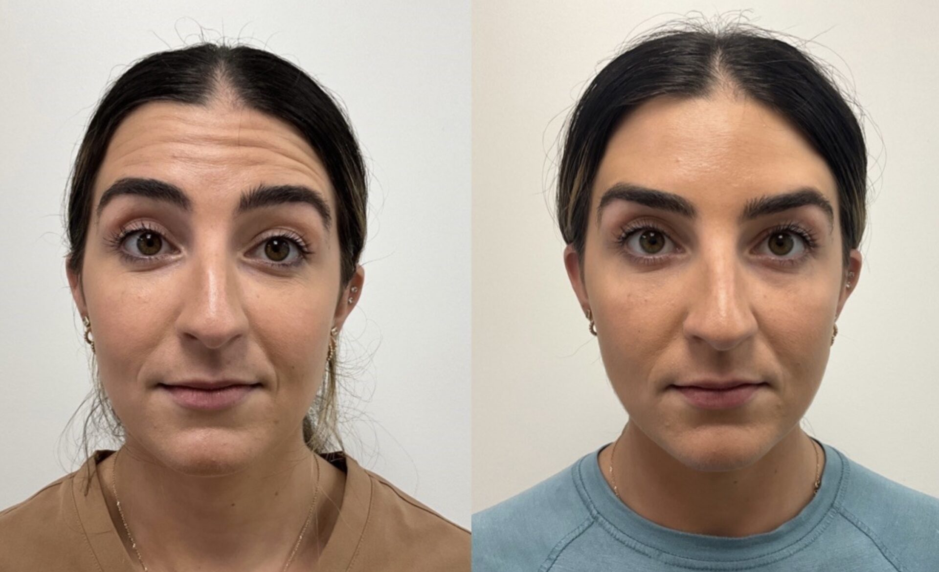 Cosmetic Botox Treatment before and after | Medical Spa West Palm Beach, FL