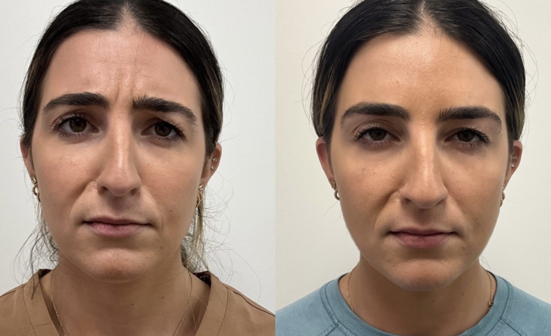 Facial Wrinkles before and after injections | Medical Spa West Palm Beach, FL