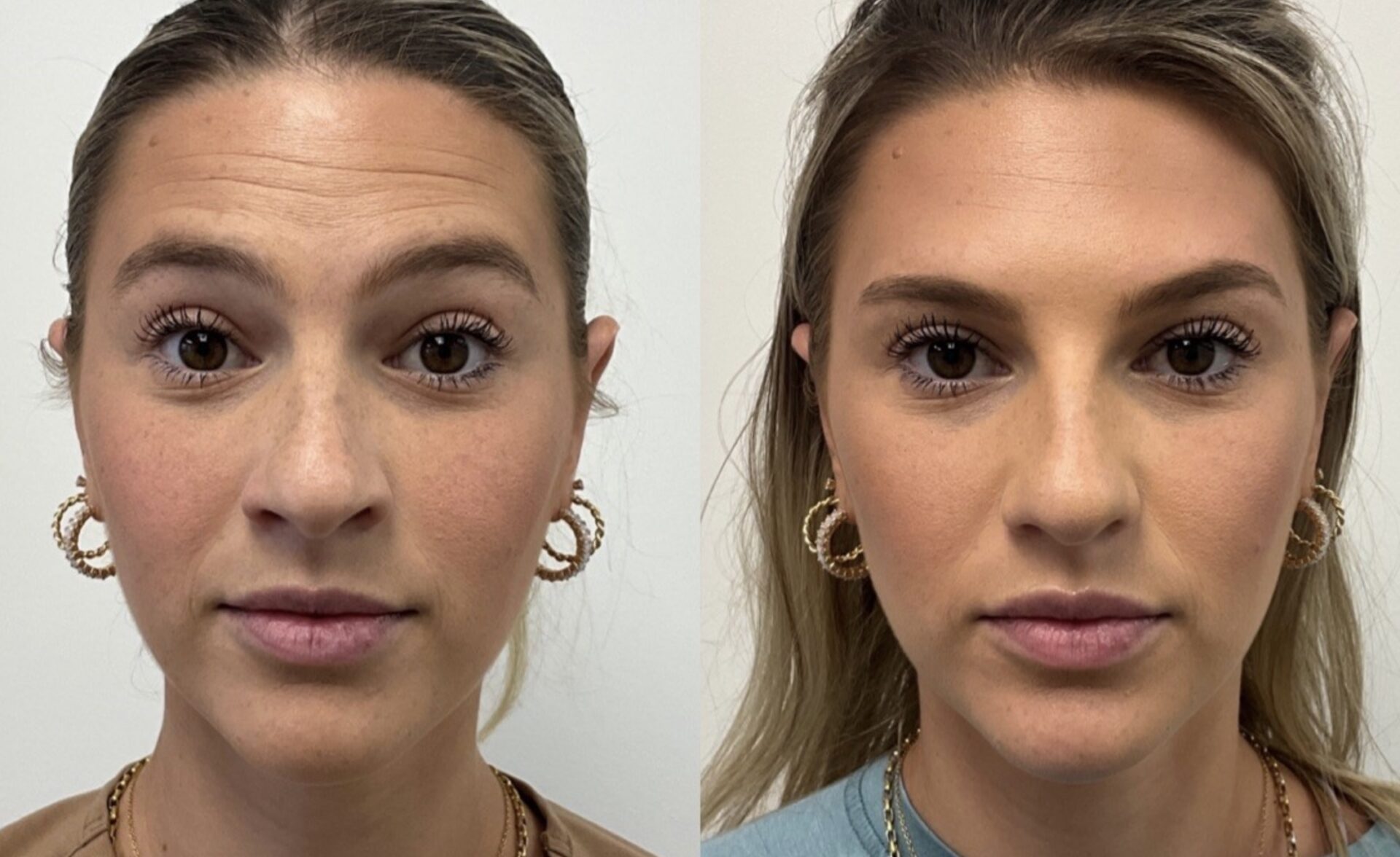 Effective botox treatment before and after | Medical Spa West Palm Beach, FL
