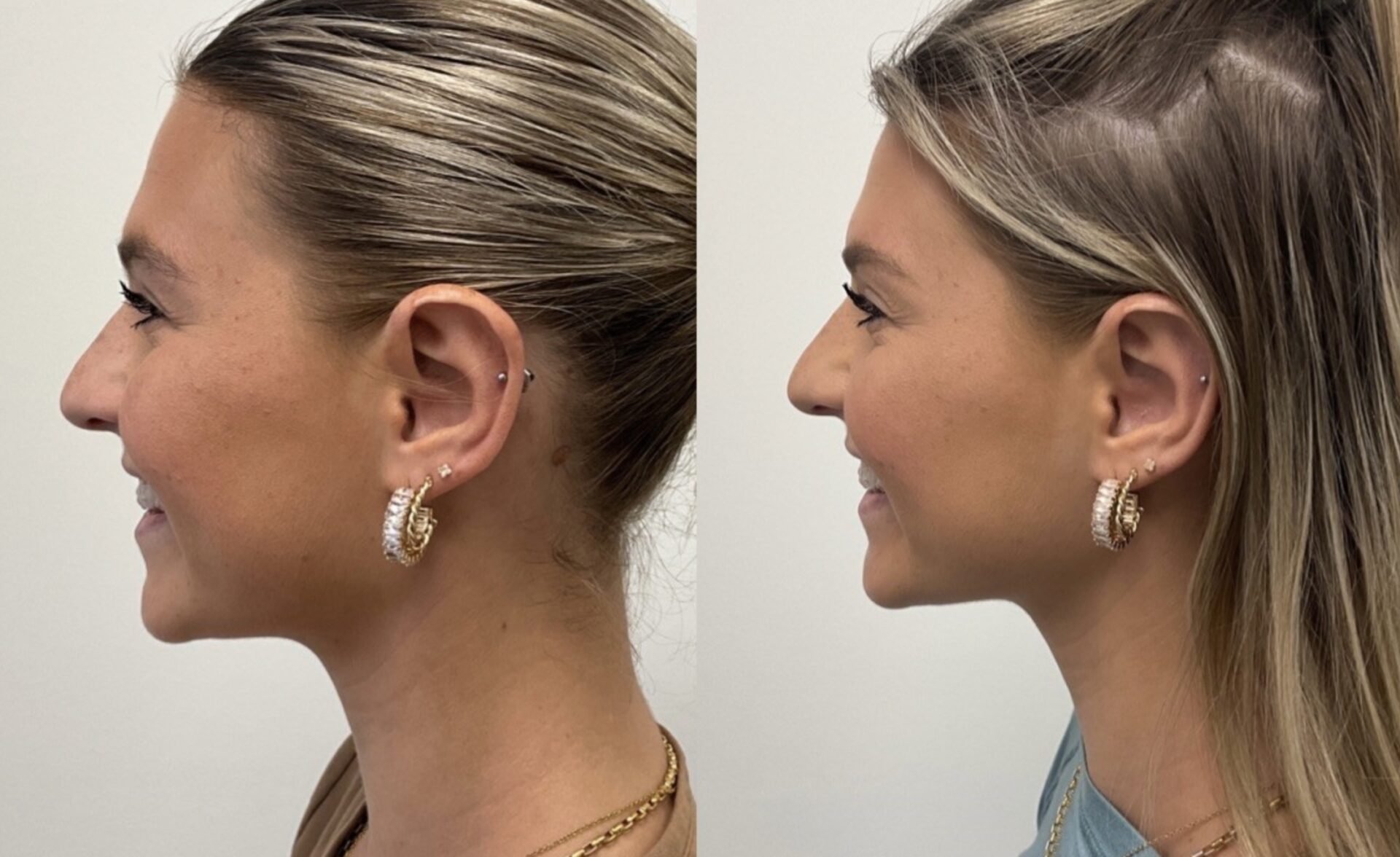 Before and after skin treatment | Medical Spa West Palm Beach, FL