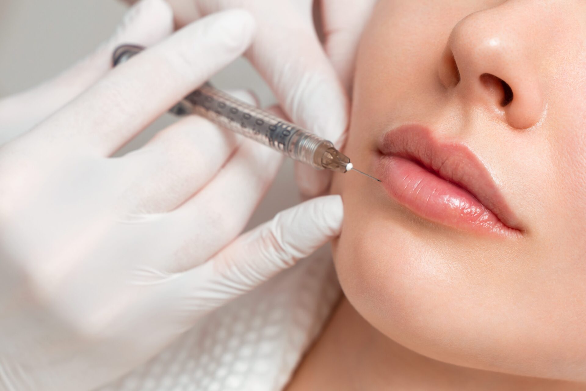 Lip Augmentation in West Palm Beach, FL | Lip Fillers